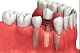 implantatum